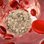 Leucemia -Foto https://www.fondazioneveronesi.it/