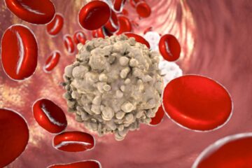 Nuova scoperta su Exportin-1: possibili cure per la leucemia