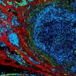 Breast tumor -Foto Jennifer Munson