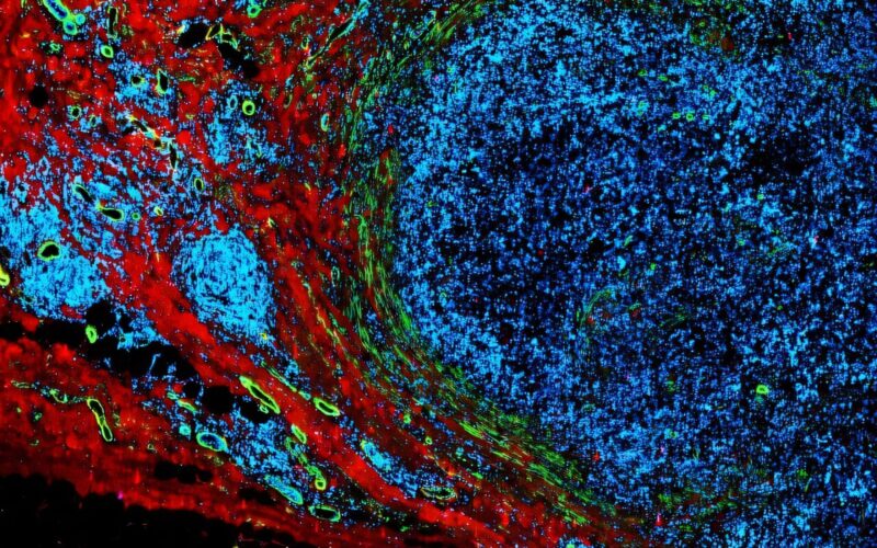 Impulsi elettrici a bassa intensità per stimolare il sistema immunitario contro il cancro