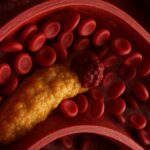 Colesterolo alto: le vere cause e come gestirlo