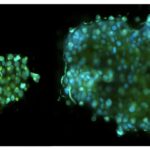 Scoperti gruppi di cellule tumorali nel sangue: svolta sulle metastasi