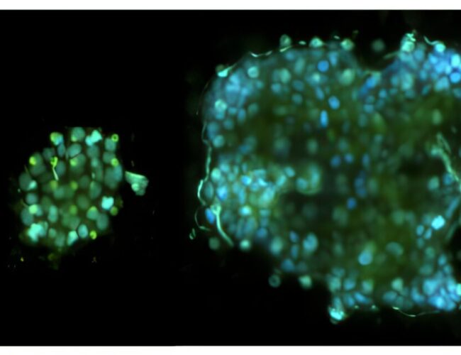 Scoperti gruppi di cellule tumorali nel sangue: svolta sulle metastasi