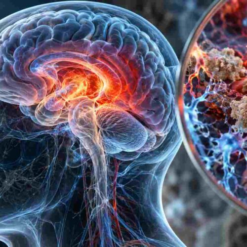Alzheimer, un farmaco sperimentale riduce l’infiammazione nel tessuto cerebrale